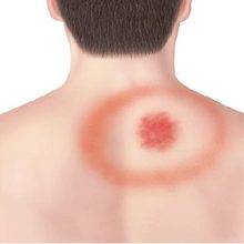 tick rash